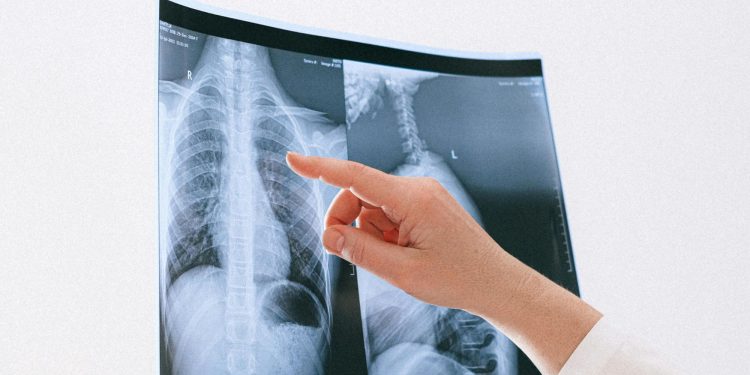 Πνευμονική υπέρταση