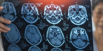 σε κλινική δοκιμή Φάσης 2