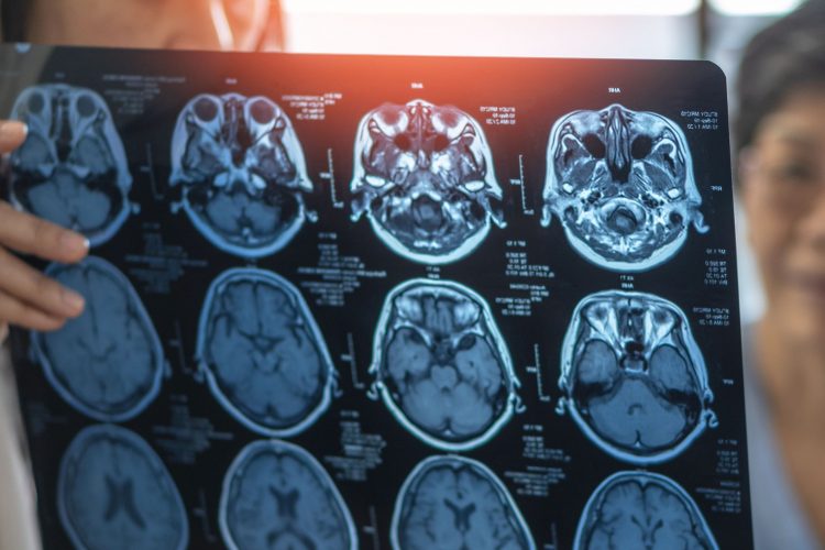 σε κλινική δοκιμή Φάσης 2