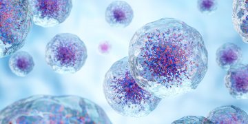 Η παχυσαρκία ισχυρότατος παράγοντας καρκίνου του ενδομητρίου