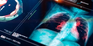 Αυξάνεται ο Καρκίνος του Πνεύμονα σε άτομα που δεν κάπνισαν ποτέ