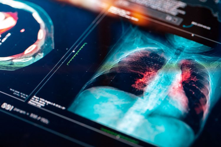 Αυξάνεται ο Καρκίνος του Πνεύμονα σε άτομα που δεν κάπνισαν ποτέ