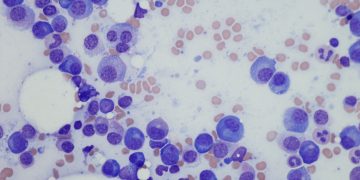 Πολλαπλούν μυέλωμα