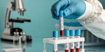 Εξέταση αίματος αρκετά ακριβής βρίσκει την νόσο Αλτσχάιμερ σε πρώιμο στάδιο