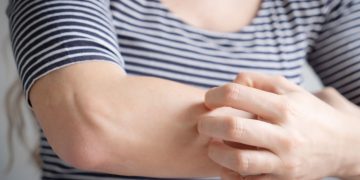 Γιατί τα κουνούπια δεν τσιμπάνε όλους μας το ίδιο;