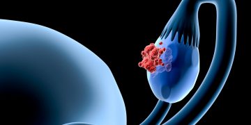 Επαναπροσδιορίζοντας τον καρκίνο των ωοθηκών στην Ελλάδα