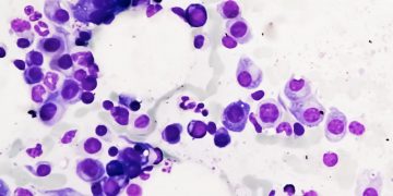 Ξεκινάει στην Αγγλία η θεραπεία: «Δούρειος Ίππος» για το Πολλαπλό Μυέλωμα