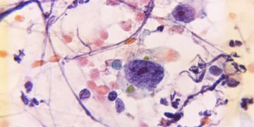 Νέα μελέτη αποκαλύπτει σημαντικές πληροφορίες για την αντιμετώπιση του καρκίνου του μαστού  