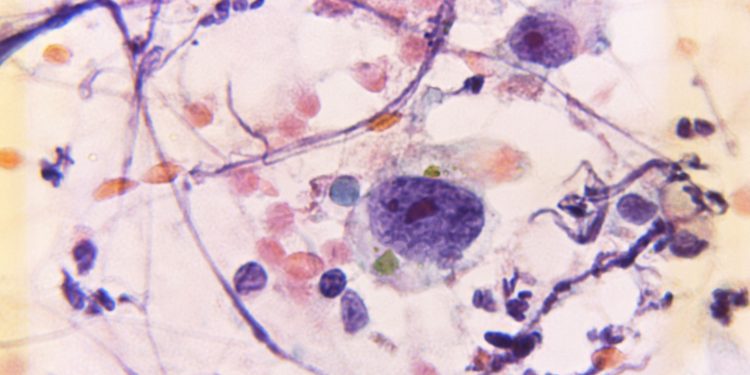 Νέα μελέτη αποκαλύπτει σημαντικές πληροφορίες για την αντιμετώπιση του καρκίνου του μαστού  