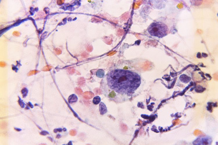 Νέα μελέτη αποκαλύπτει σημαντικές πληροφορίες για την αντιμετώπιση του καρκίνου του μαστού  