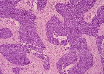 Σημαντική συμμετοχή της Θεραπευτικής Κλινικής ΕΚΠΑ στο Διεθνές Συνέδριο για το Πολλαπλούν Μυέλωμα στο Τορόντο του Καναδά