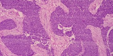 Σημαντική συμμετοχή της Θεραπευτικής Κλινικής ΕΚΠΑ στο Διεθνές Συνέδριο για το Πολλαπλούν Μυέλωμα στο Τορόντο του Καναδά