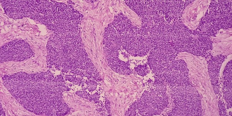 Σημαντική συμμετοχή της Θεραπευτικής Κλινικής ΕΚΠΑ στο Διεθνές Συνέδριο για το Πολλαπλούν Μυέλωμα στο Τορόντο του Καναδά