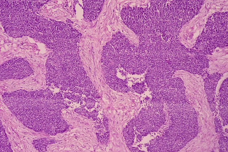 Σημαντική συμμετοχή της Θεραπευτικής Κλινικής ΕΚΠΑ στο Διεθνές Συνέδριο για το Πολλαπλούν Μυέλωμα στο Τορόντο του Καναδά