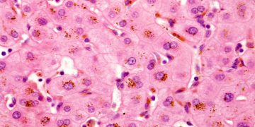 Καμπάνια ενημέρωσης για την Οικογενή Ενδοηπατική Χολόσταση