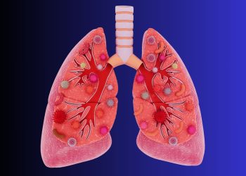 Καρκίνος του πνεύμονα σε μη καπνιστές