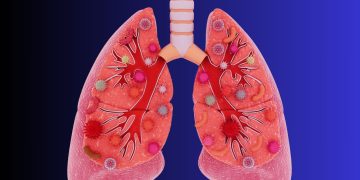 Καρκίνος του πνεύμονα σε μη καπνιστές