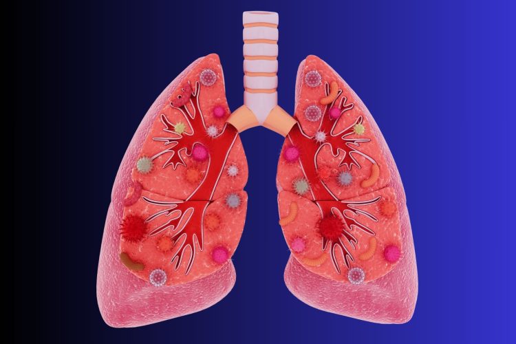 Καρκίνος του πνεύμονα σε μη καπνιστές