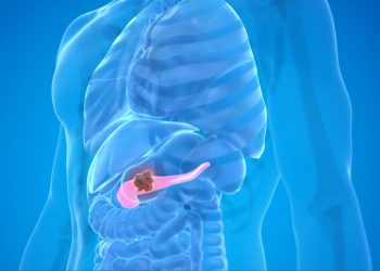 Βέλτιστη νεοεπικουρική θεραπεία για τον καρκίνο του παγκρέατος