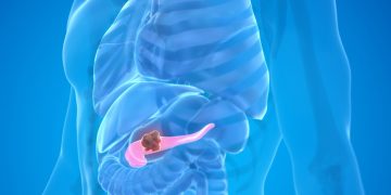 Βέλτιστη νεοεπικουρική θεραπεία για τον καρκίνο του παγκρέατος