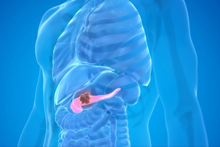 Βέλτιστη νεοεπικουρική θεραπεία για τον καρκίνο του παγκρέατος