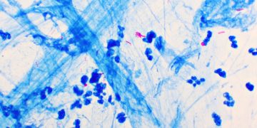 Η φυματίωση επιστρέφει στο παγκόσμιο προσκήνιο: Πόσο επηρεάζεται η Ελλάδα;