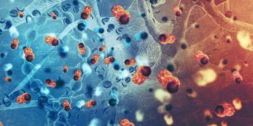 Η θεραπευτική κλινική του ΕΚΠΑ στην πρωτοπορία για το πολλαπλούν μυέλωμα και τις λοιπές πλασματοκυτταρικές δυσκρασίες