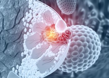 Νέα θεραπευτική αγωγή για τον μεταστατικό καρκίνο του μαστού