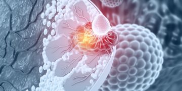 Νέα θεραπευτική αγωγή για τον μεταστατικό καρκίνο του μαστού