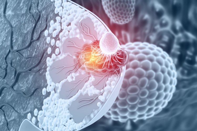 Νέα θεραπευτική αγωγή για τον μεταστατικό καρκίνο του μαστού