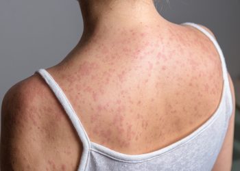 Έξαρση ιλαράς στις ΗΠΑ