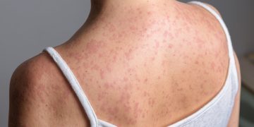 Έξαρση ιλαράς στις ΗΠΑ