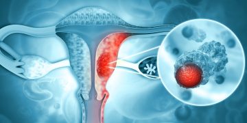 Καρκίνος του Ενδομητρίου – 2026 Update