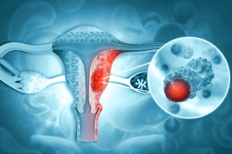 Καρκίνος του Ενδομητρίου – 2026 Update