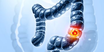 Ο καρκίνος του παχέος εντέρου είναι η κύρια αιτία θανάτου από καρκίνο στις ΗΠΑ σε άτομα ηλικίας κάτω των 50 ετών