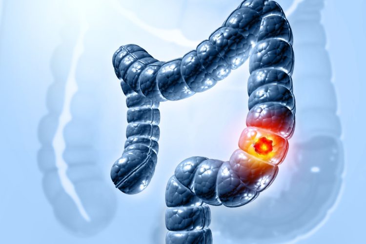 Ο καρκίνος του παχέος εντέρου είναι η κύρια αιτία θανάτου από καρκίνο στις ΗΠΑ σε άτομα ηλικίας κάτω των 50 ετών