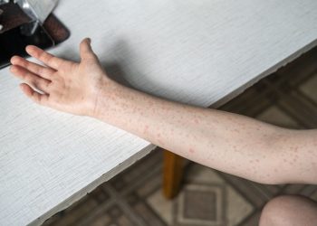 αύξηση κρουσμάτων ιλαράς