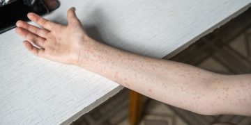 αύξηση κρουσμάτων ιλαράς