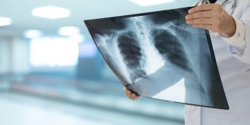 Εμβόλιο κατά του προχωρημένου καρκίνου του πνεύμονα