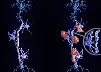 Σκλήρυνση κατά πλάκας: Ένα νέο φάρμακο φέρνει ελπίδα για όσους ζουν με προοδευτική μορφή της νόσου