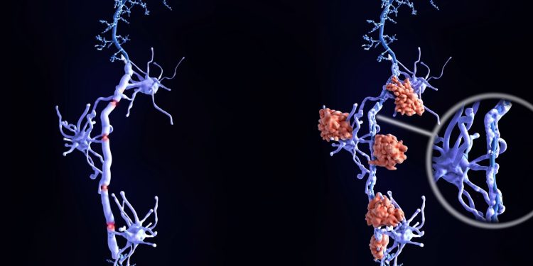 Σκλήρυνση κατά πλάκας: Ένα νέο φάρμακο φέρνει ελπίδα για όσους ζουν με προοδευτική μορφή της νόσου