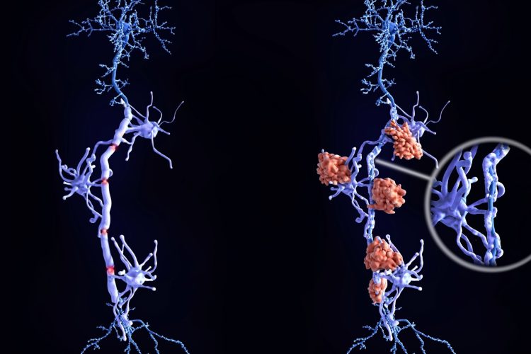 Σκλήρυνση κατά πλάκας: Ένα νέο φάρμακο φέρνει ελπίδα για όσους ζουν με προοδευτική μορφή της νόσου