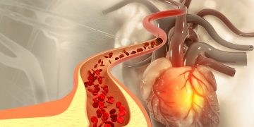 LDL χοληστερόλη