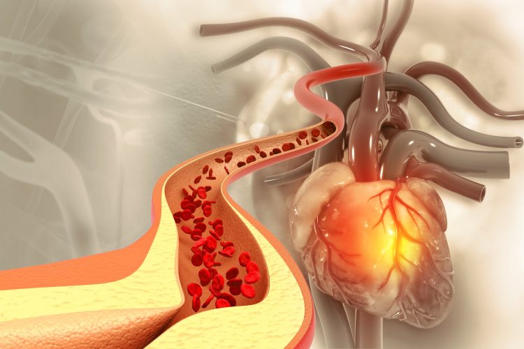 LDL χοληστερόλη