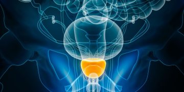 Προσθήκη ορμονικής θεραπείας στη μετεγχειρητική ακτινοθεραπεία για τον καρκίνο του προστάτη: Ποιοι ασθενείς ωφελούνται;