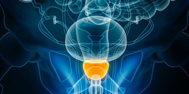 Προσθήκη ορμονικής θεραπείας στη μετεγχειρητική ακτινοθεραπεία για τον καρκίνο του προστάτη: Ποιοι ασθενείς ωφελούνται;