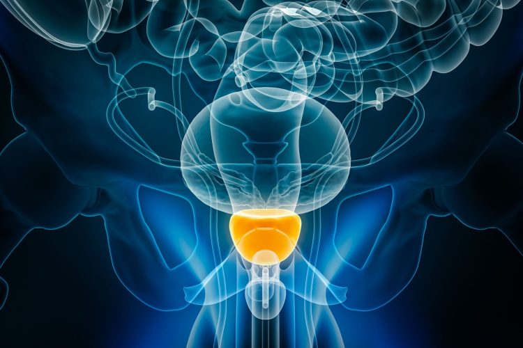 Προσθήκη ορμονικής θεραπείας στη μετεγχειρητική ακτινοθεραπεία για τον καρκίνο του προστάτη: Ποιοι ασθενείς ωφελούνται;