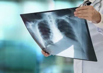 Καρκίνος του πνεύμονα σε μη καπνιστές