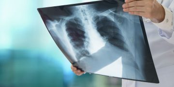 Καρκίνος του πνεύμονα σε μη καπνιστές