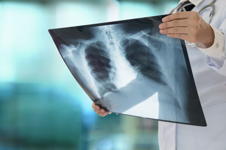 Καρκίνος του πνεύμονα σε μη καπνιστές